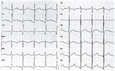 Case Report: Unexplained Fever and Chest Pain in a 5-Year-Old